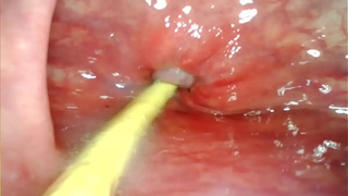 EXTREME ANAL SELF PERSPECTIVE. ONLINE CAM INSIDE HER BUTT-HOLE AS I POUND HER WITH MY GIGANTIC COCK AND SPUNK DEEP INSIDE