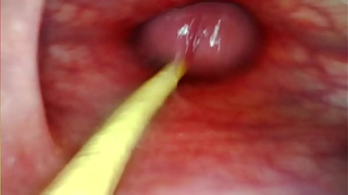 EXTREME ANAL POINT OF VIEW. WEB-CAM INSIDE HER BUTTHOLE AS I POUND HER WITH MY MONSTROUS COCK AND SPUNK DEEP INSIDE