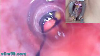 Older Woman Peehole Endoscope Cam in Bladder with Balls